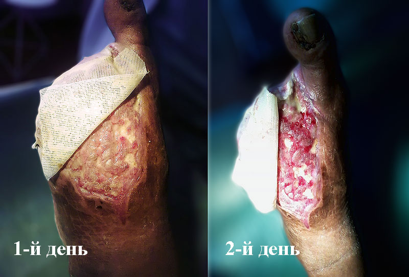 Диабетическая ангиопатия, диабетическая ангиопатия нижних конечностей, диабетическая ангиопатия сосудов нижних конечностей Диабетическая ангиопатия, диабетическая ангиопатия нижних конечностей, диабетическая ангиопатия сосудов нижних конечностей